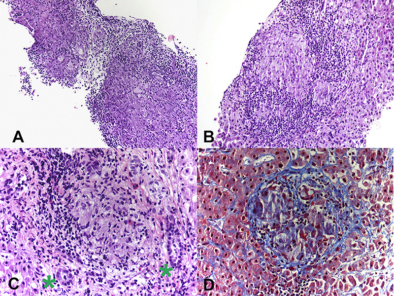 Sarcoidosis: Overview, Symptoms, Diagnosis & Treatment Options