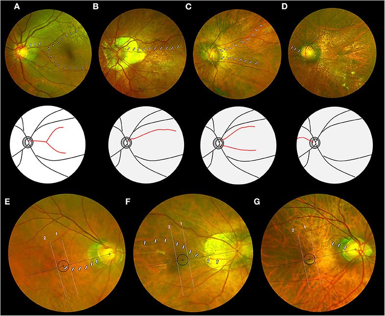 Macular Degeneration: Overview, Types, Causes, and Treatments