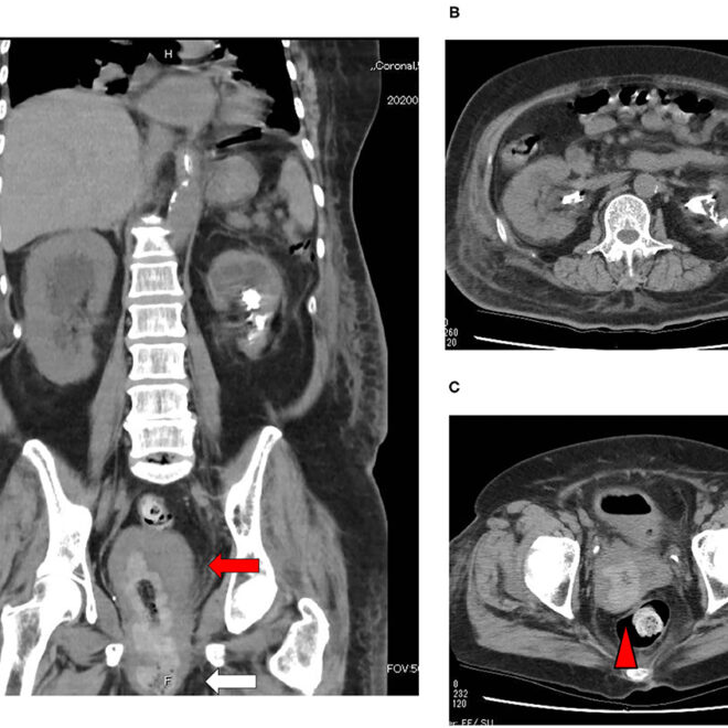 Prolapsed Uterus (Uterine Prolapse): Overview, Symptoms, Causes & Treatments