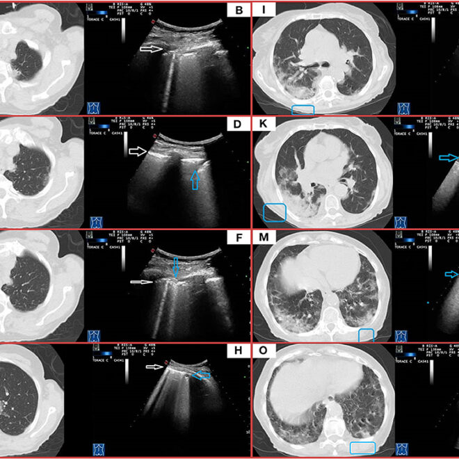 Pleural Empyema: Causes, Symptoms, Diagnosis, and Treatment