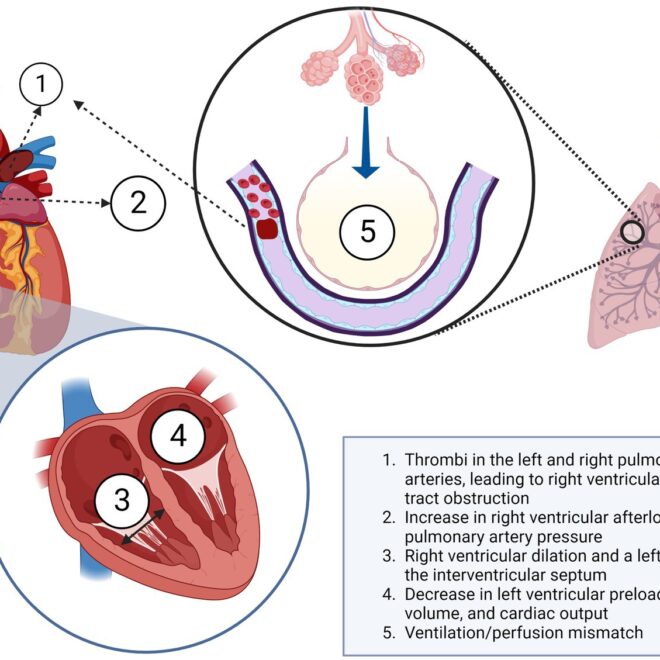 Pulmonary Embolism: Causes, Symptoms, Diagnosis, and Treatment