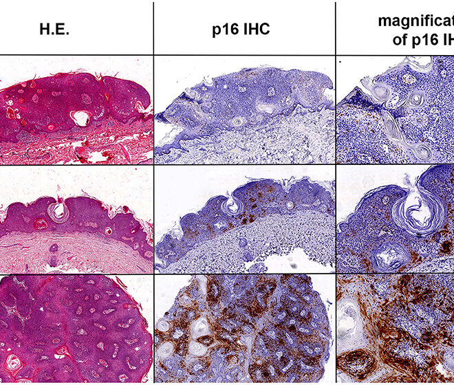 Seborrheic Keratosis: Overview, Causes, Symptoms & Removal