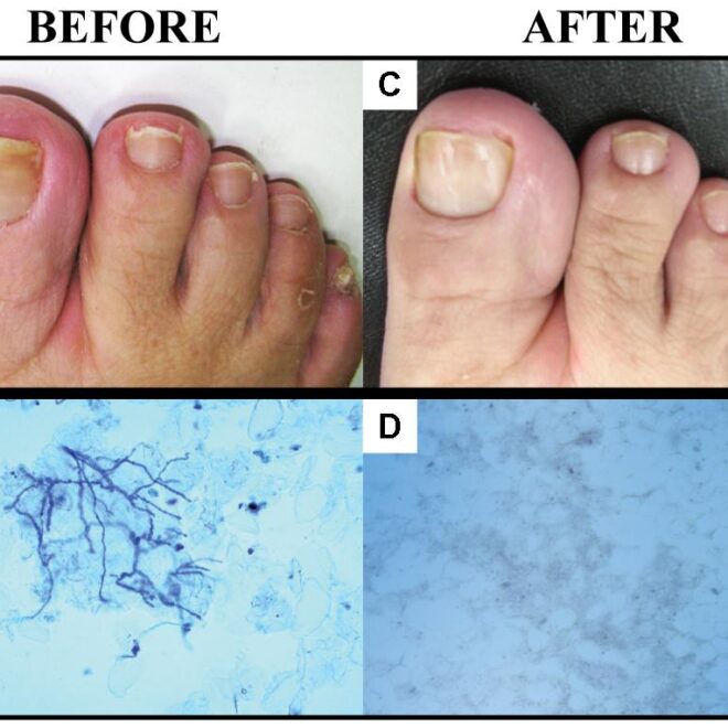 Nail Fungal Infection (Onychomycosis): Causes, Symptoms & Treatments