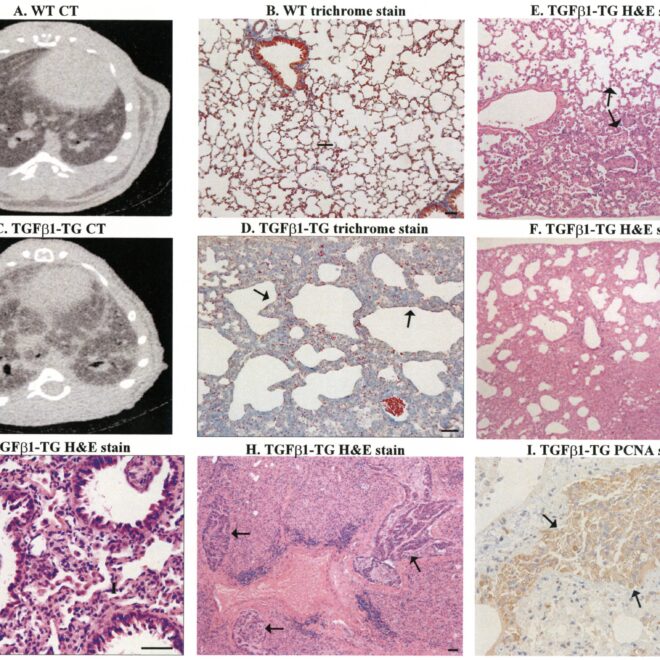 Pulmonary Fibrosis: Understanding Scarring of Lung Tissue (Pulmonary Fibrosis)