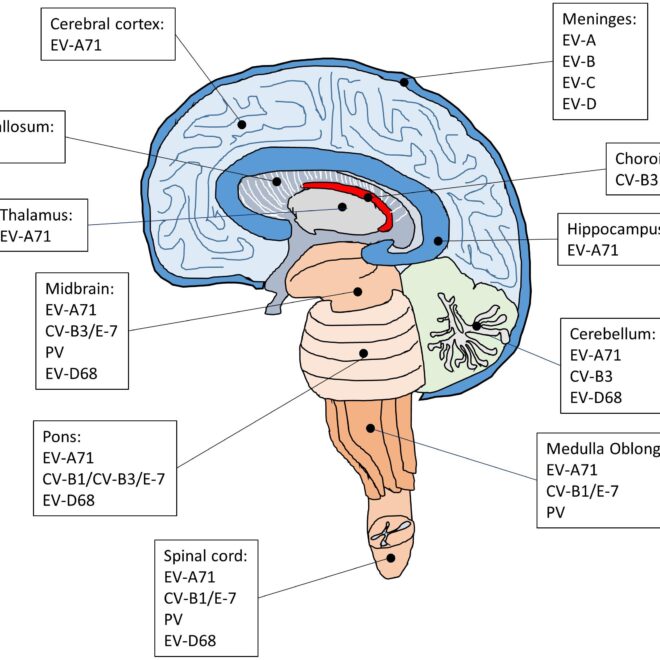 Encephalitis: Causes, Symptoms, Diagnosis, and Treatment (Brain Inflammation Explained)