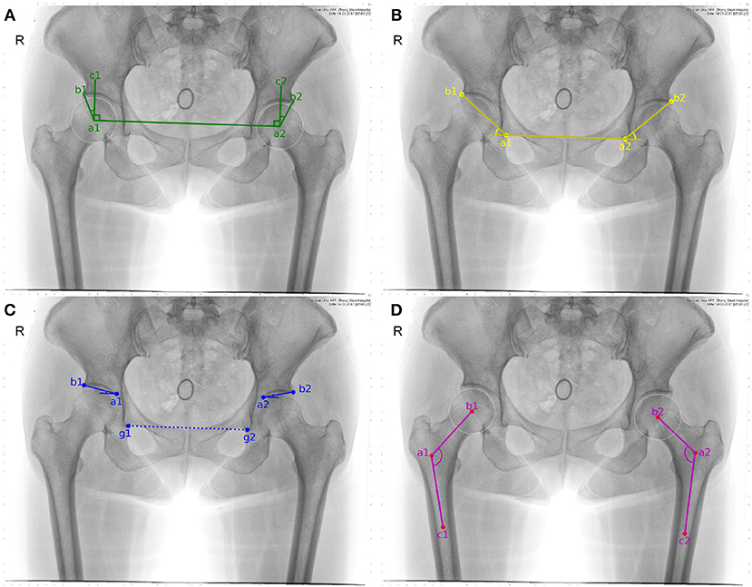 Hip Dysplasia: A Complete Guide to Understanding the Condition (Developmental Hip Disorder)