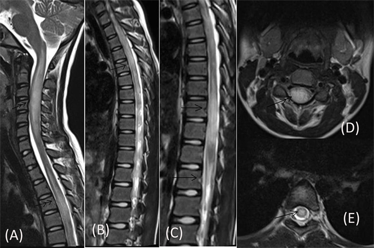 Neuromyelitis Optica (NMO): A Detailed Overview of Symptoms, Diagnosis, and Treatments