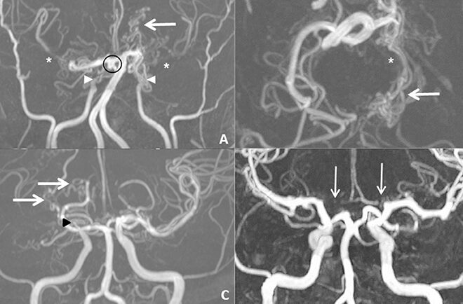Moyamoya Disease: Causes, Symptoms, Diagnosis & Treatment (Cerebrovascular Disorder)