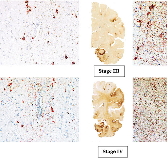 Chronic Traumatic Encephalopathy (CTE): Causes, Symptoms, Diagnosis & Care