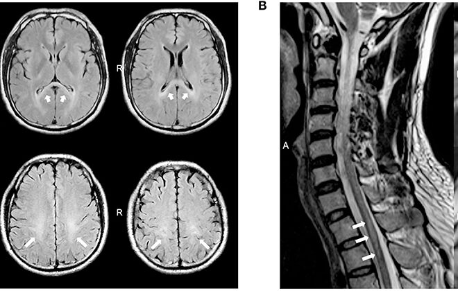 Krabbe Disease: Understanding the Rare Genetic Disorder (Globoid Cell Leukodystrophy)