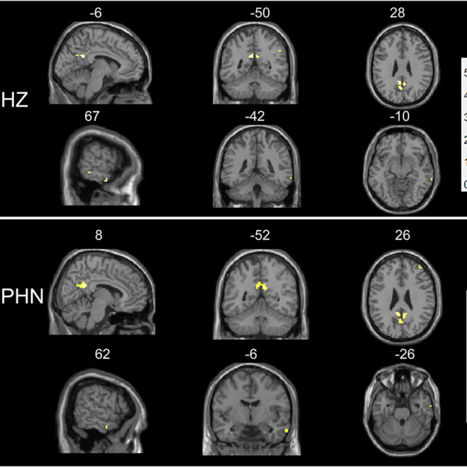 Postherpetic Neuralgia (Nerve Pain After Shingles)