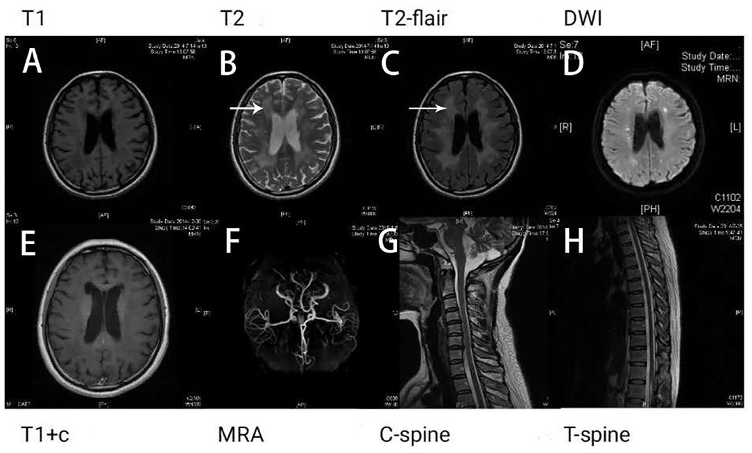 Metachromatic Leukodystrophy (MLD): A Guide to Understanding the Disease