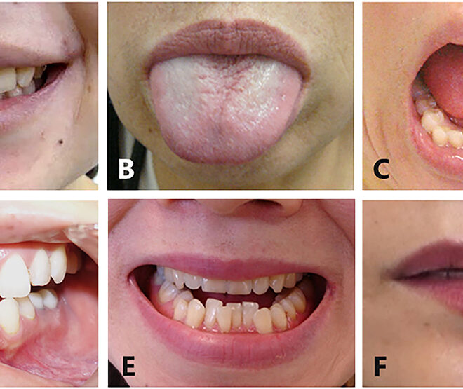 Tardive Dyskinesia: Causes, Symptoms, Diagnosis, and Treatment