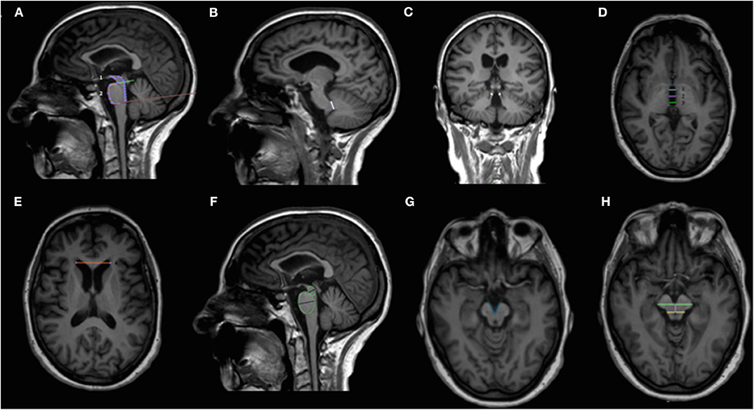 Progressive Supranuclear Palsy: Overview, Symptoms, Diagnosis & Care