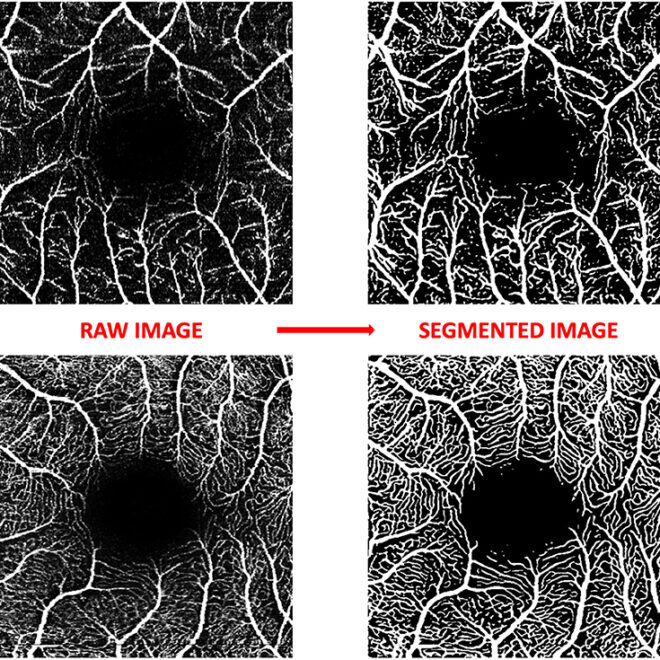 Optic Neuritis: Causes, Symptoms, Diagnosis, and Treatment (Inflammation of the Optic Nerve)