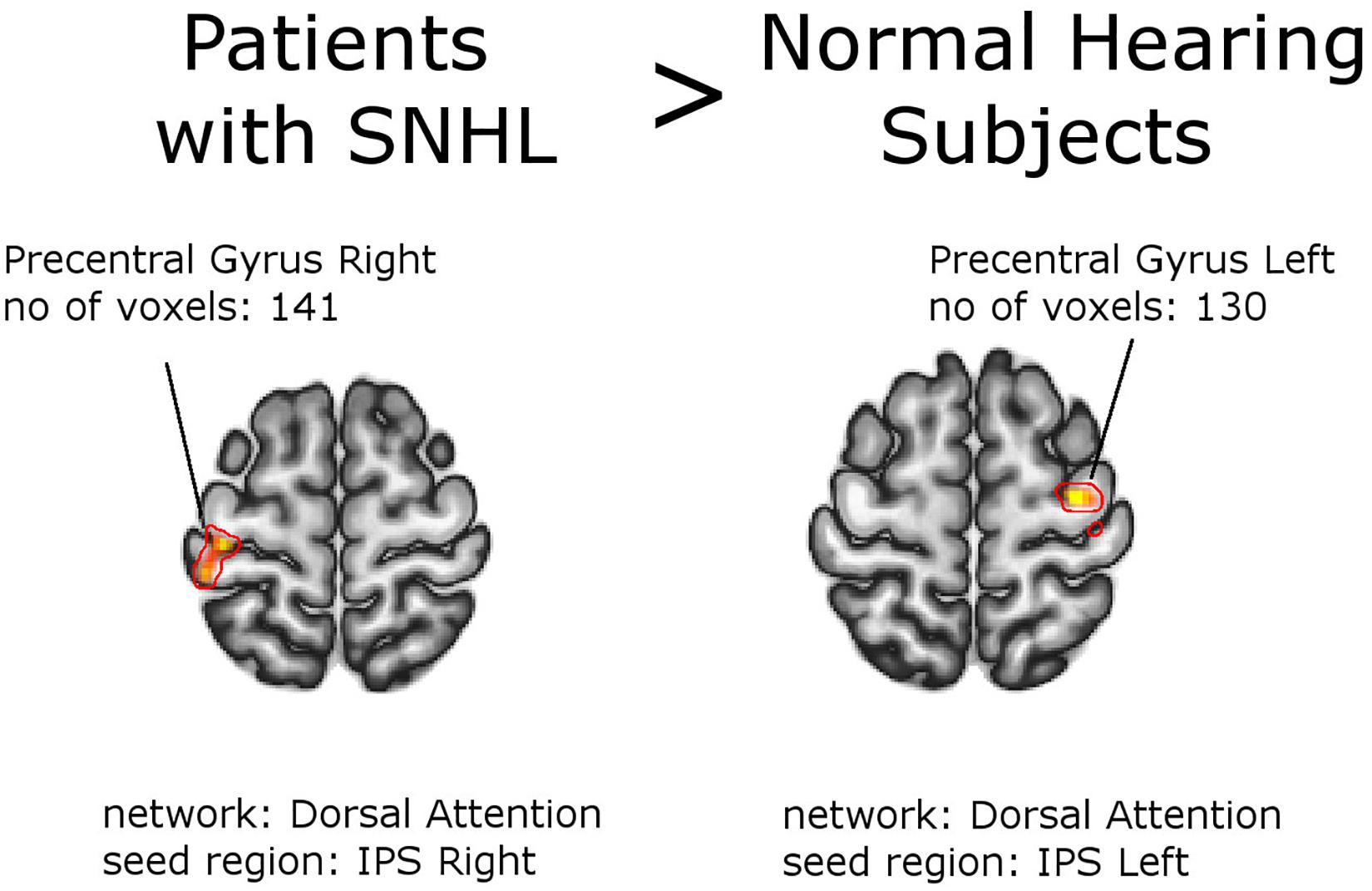 Sensorineural Hearing Loss (Nerve Damage): Causes, Symptoms, and Treatments