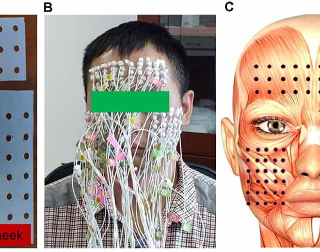 Bell’s Palsy: Causes, Symptoms, Diagnosis, and Treatment (Facial Paralysis)
