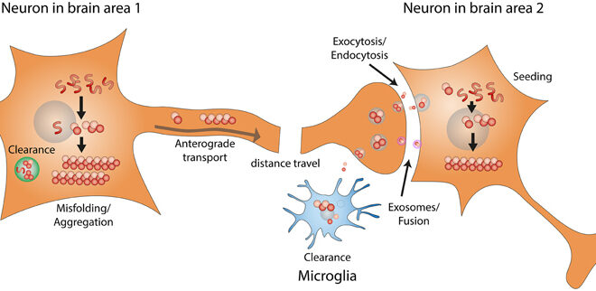 Lewy Body Dementia: Overview, Symptoms, Diagnosis, and Care