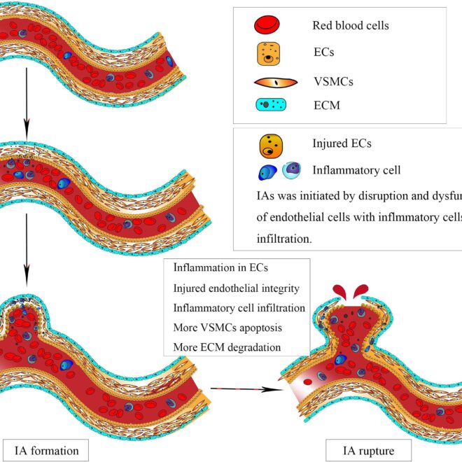 Brain Aneurysm: What It Is, Causes, Symptoms & Treatment