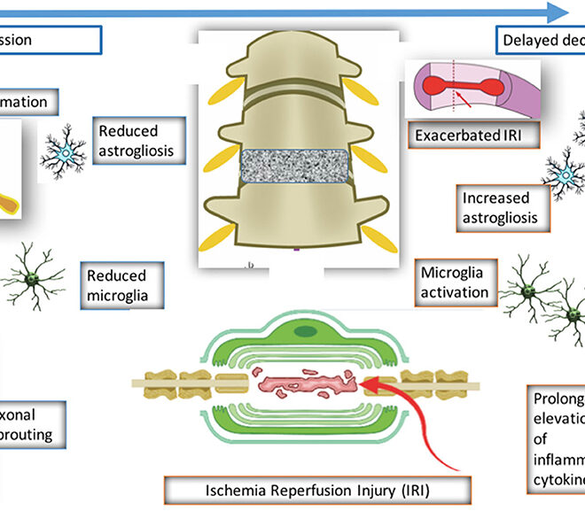Spinal Cord Compression (Myelopathy): Causes, Symptoms, and Treatments