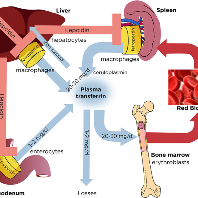 Iron Overload Disorder (Hemochromatosis): Causes, Symptoms, Diagnosis & Management