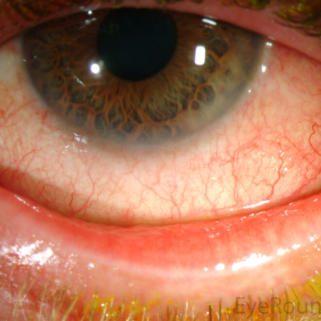 Pink Eye (Conjunctivitis): Causes, Symptoms, and Treatments