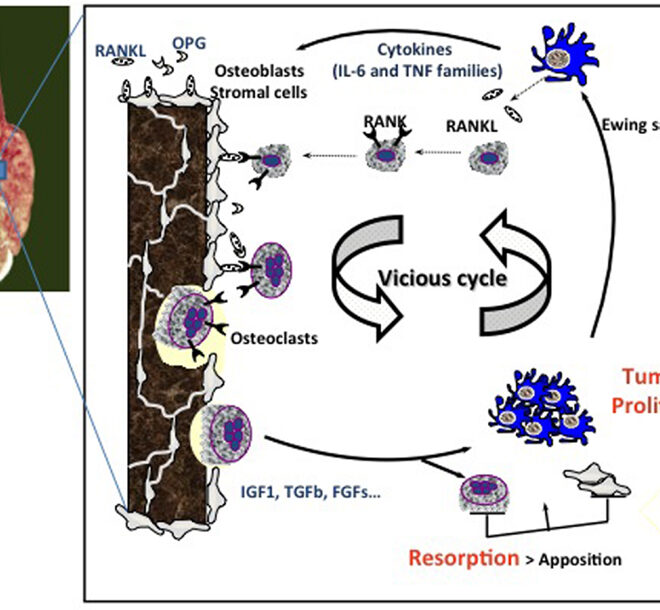 Ewing Sarcoma: Understanding the Bone Cancer Affecting Children and Young Adults