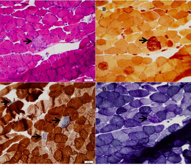 Rhabdomyolysis: Causes, Symptoms, Diagnosis, and Treatment (Muscle Breakdown Disorder)