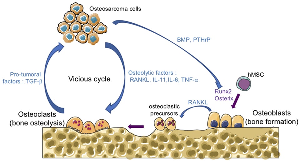 Bone Cancer (Osteosarcoma): Types, Causes, Diagnosis & Treatment