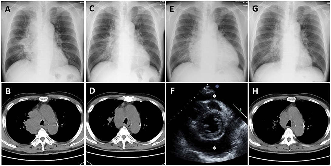 Pericardial Effusion: Causes, Symptoms, Diagnosis & Treatment