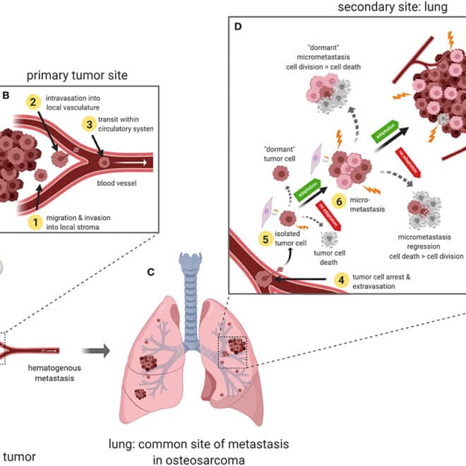 Bone Cancer (Osteosarcoma): Types, Causes, Diagnosis & Treatment