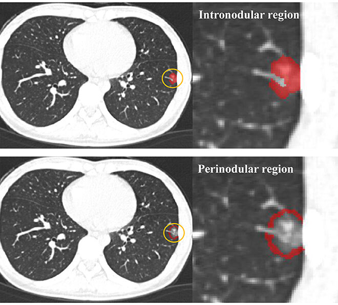 Lung Nodules: Overview, Types, Diagnosis, and Treatment Options