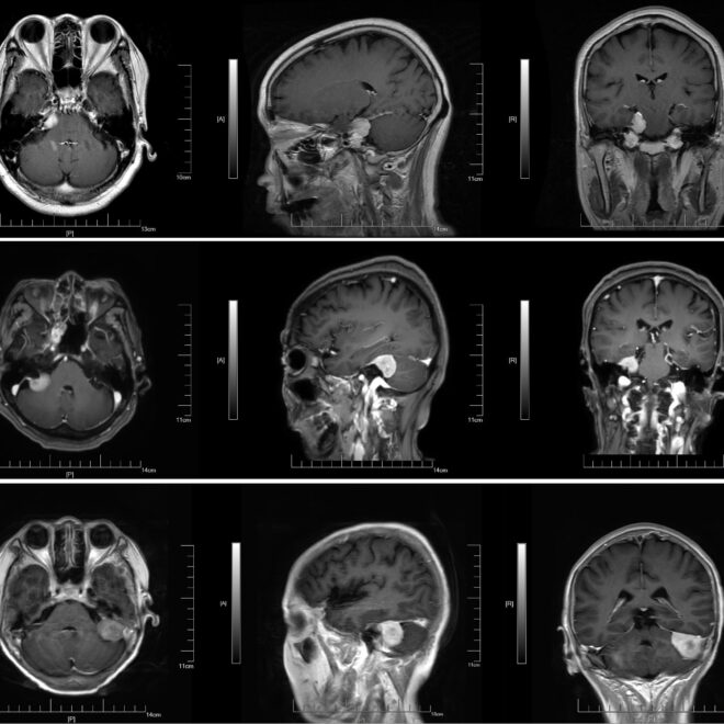 Meningioma Brain Tumor: Overview, Causes, Diagnosis, and Treatments
