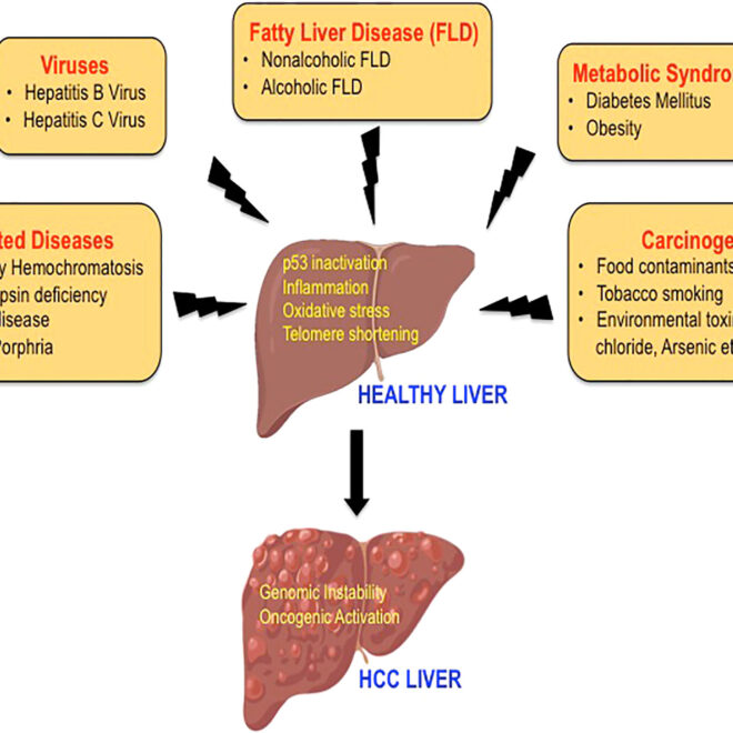 Liver Cancer (Hepatocellular Carcinoma): Overview, Causes, Symptoms & Treatments