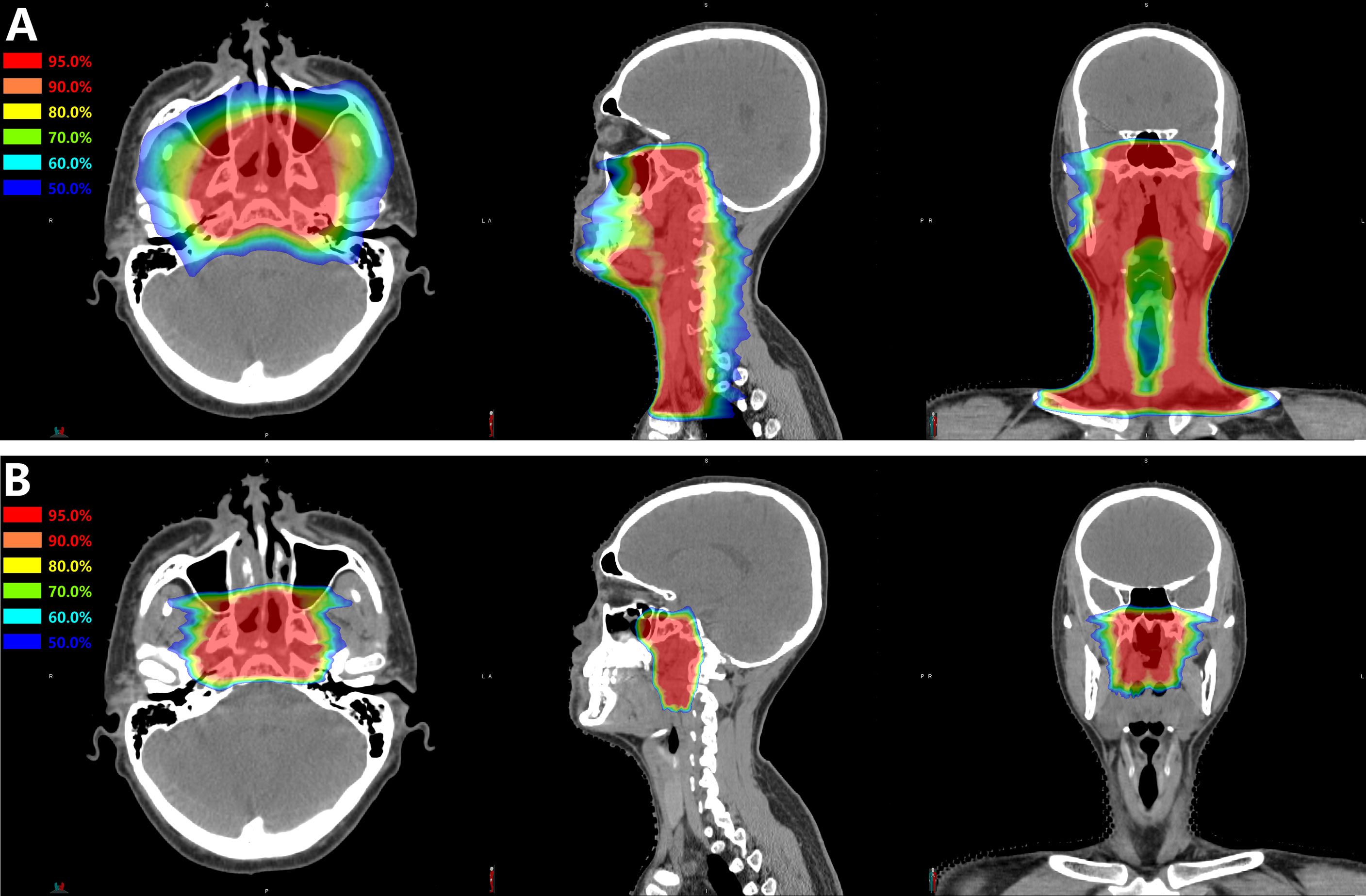 Nasopharyngeal Cancer (NPC): Overview, Causes, Symptoms & Treatments