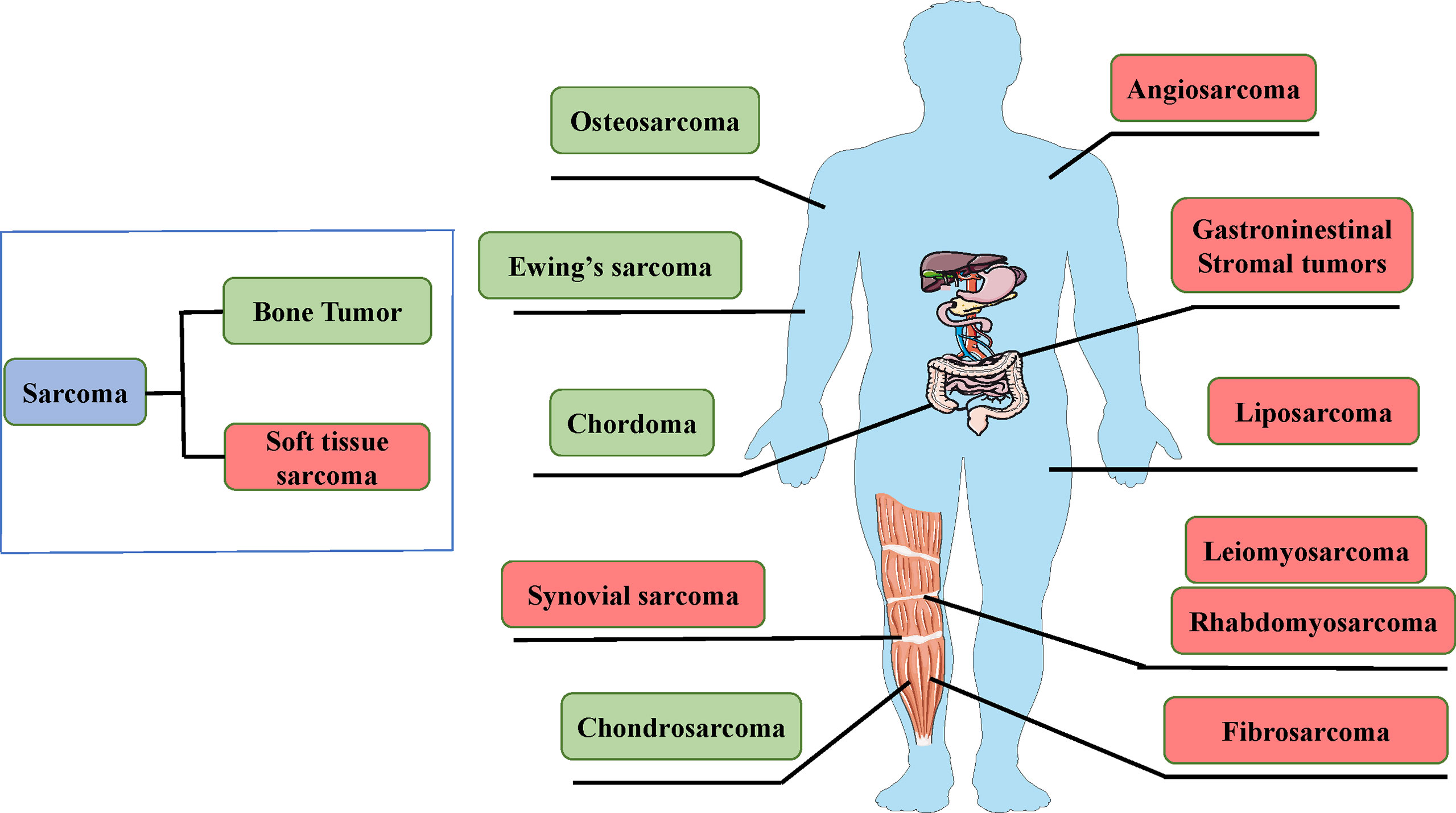 Soft Tissue Sarcoma: Types, Causes, Symptoms, Diagnosis & Treatment