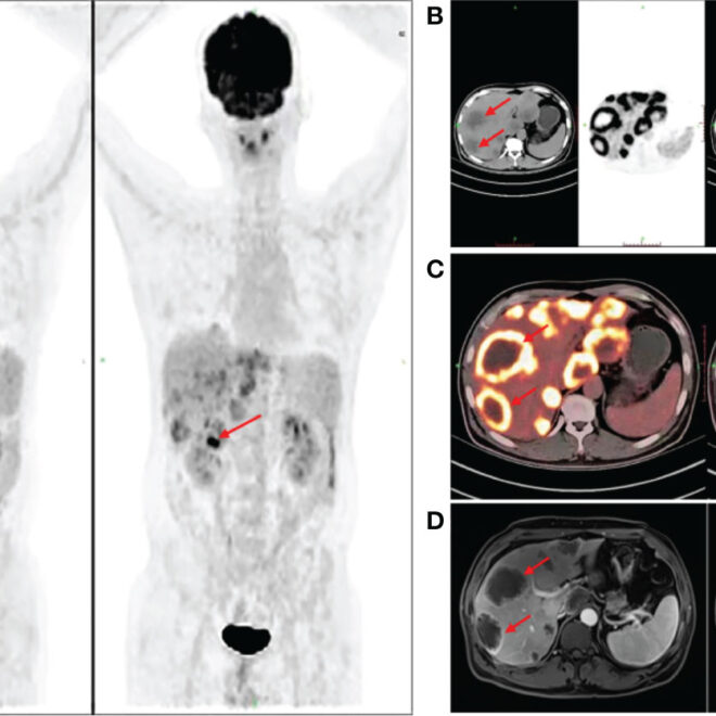 Rectal Cancer: Causes, Symptoms, Diagnosis, and Treatments