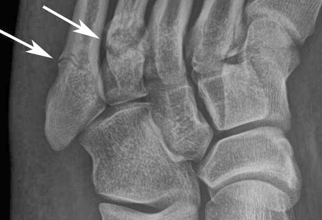 Stress Fracture: Causes, Symptoms, Diagnosis, and Treatment