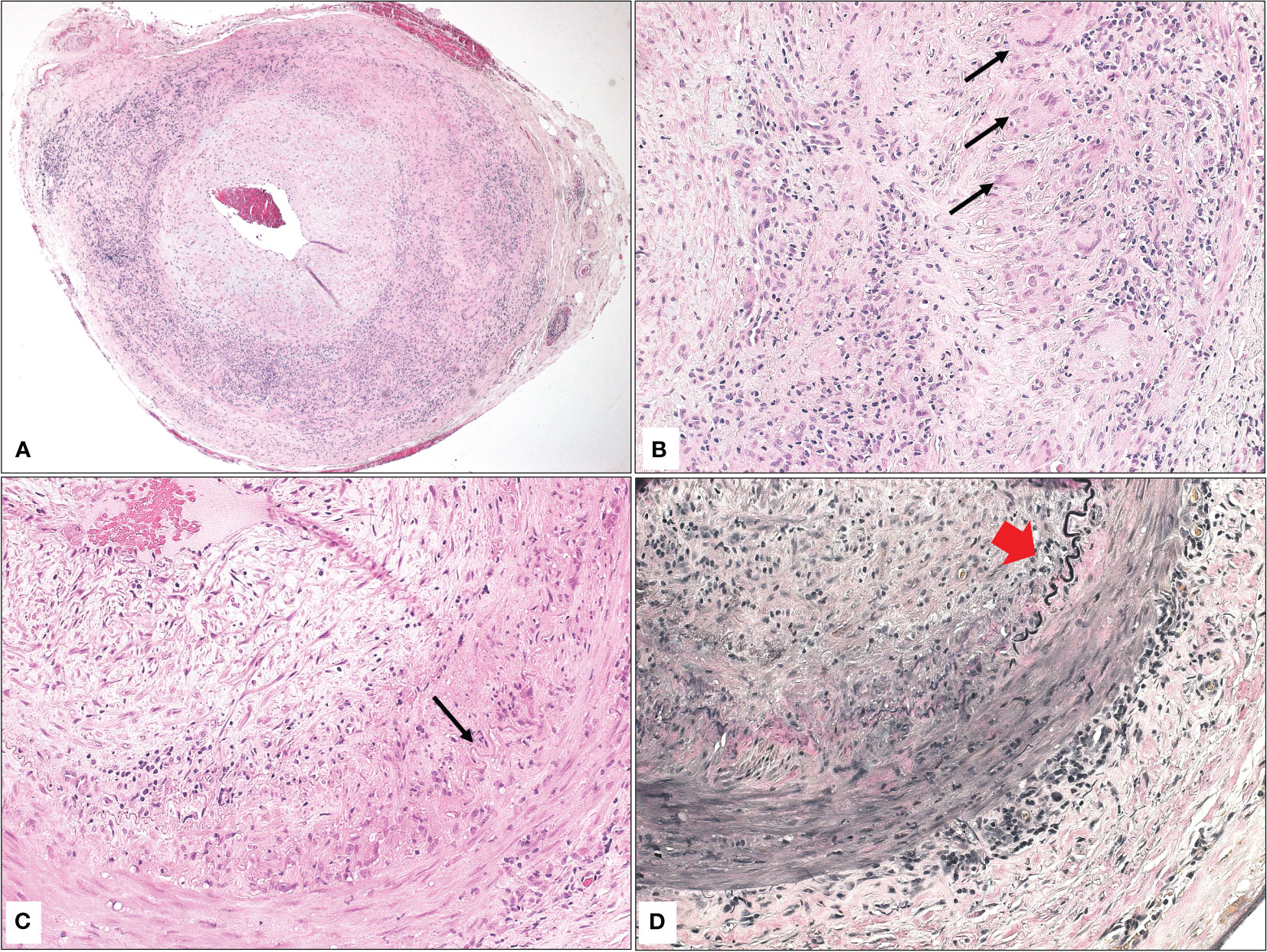 Temporal Arteritis (Giant Cell Arteritis): Symptoms, Diagnosis, and Treatment