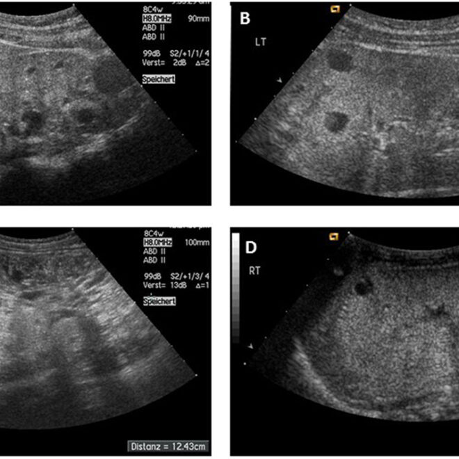 Polycystic Kidney Disease: Causes, Symptoms, Diagnosis, and Treatment Options