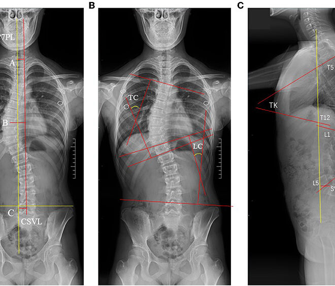 Scoliosis: Understanding the Curvature of the Spine (Scoliosis)