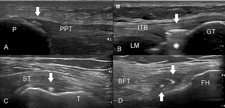 Iliotibial Band Syndrome: Causes, Symptoms, and Treatments