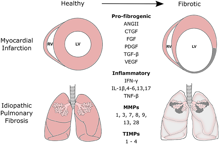 Pulmonary Fibrosis: Understanding Scarring of Lung Tissue (Pulmonary Fibrosis)