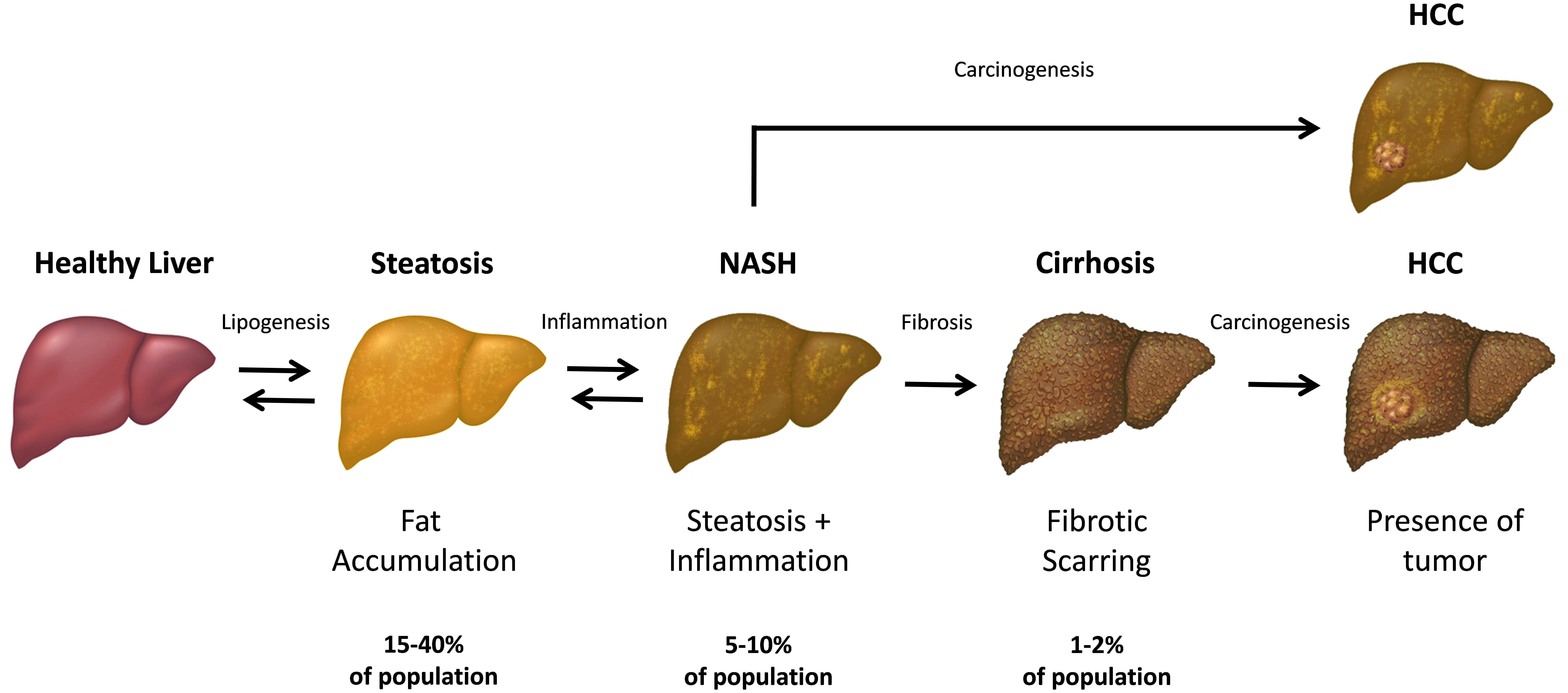 Nonalcoholic Fatty Liver Disease: Causes, Symptoms, Diagnosis & Care