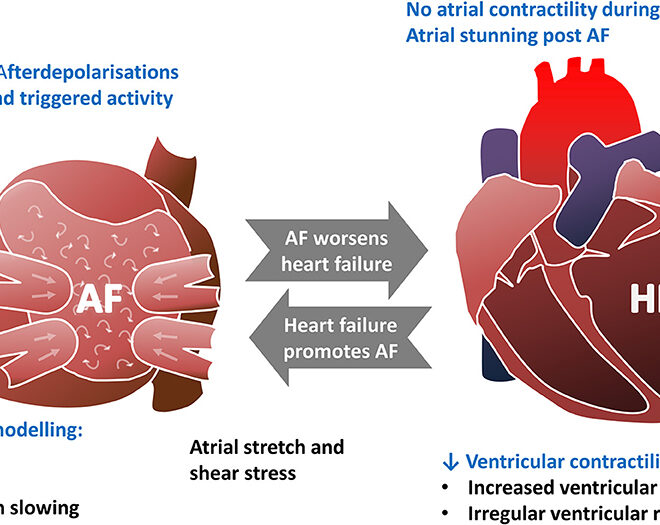 Atrial Fibrillation: What It Is, Causes, Symptoms & Treatment