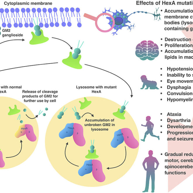 Tay-Sachs Disease: Understanding the Genetic Disorder