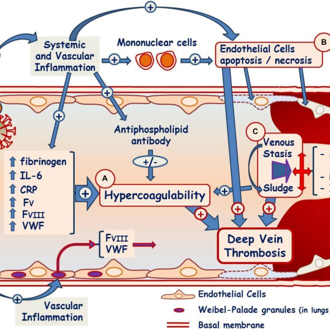 Blood Clot Blockage (Embolism): Types, Causes, Effects, and Treatments