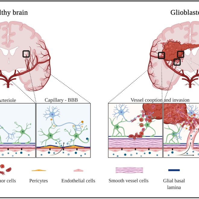 Brain Tumors: Types, Causes, Symptoms & Treatments