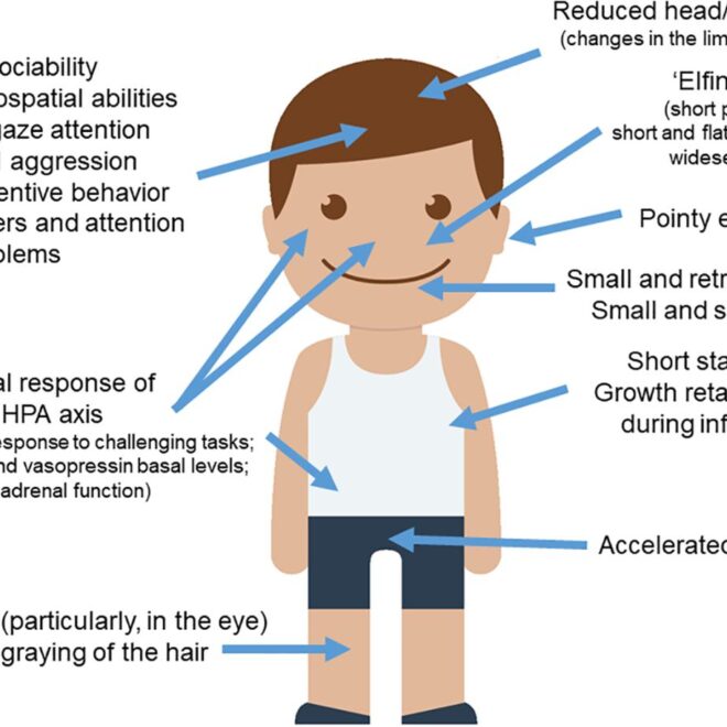 Williams Syndrome: A Genetic Disorder Explained