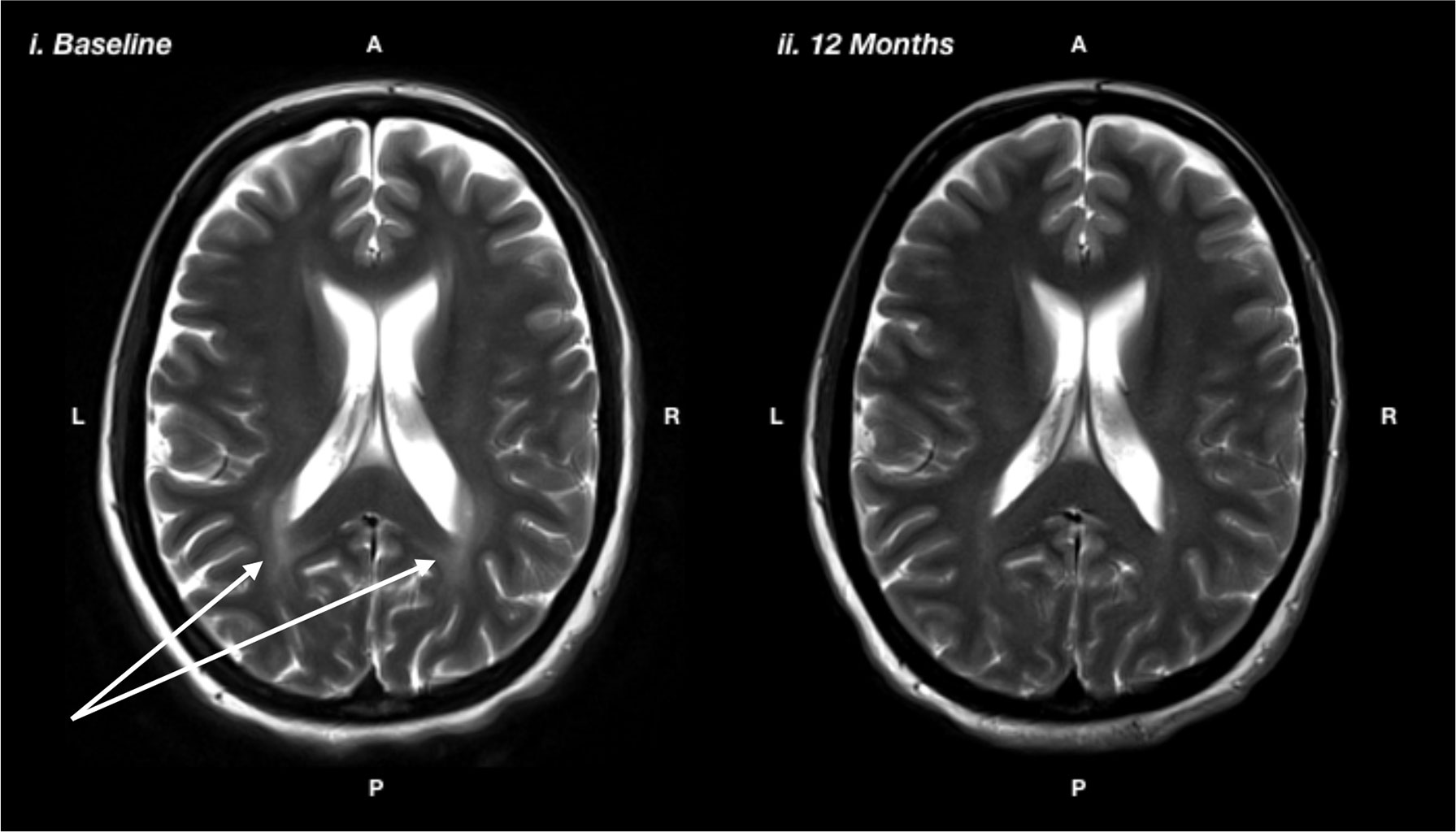 Phenylketonuria (PKU): Causes, Symptoms, Diagnosis, and Management